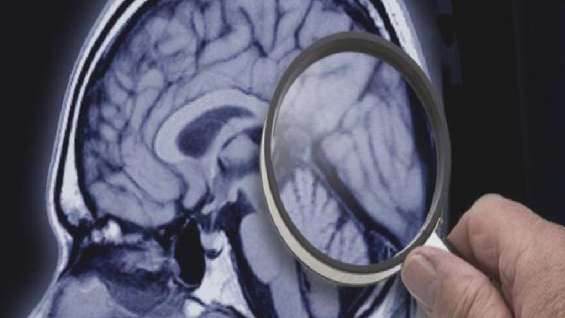 Demans ve Alzheimer: Belirtileri nedir, hangi tedaviler uygulanıyor?