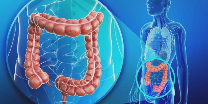 İnflamatuar bağırsak hastalığı: İngiliz araştırmacılar hastalığın başlıca nedenlerinden birini buldu