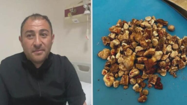 Böbreklerinden 300’ü aşkın taş çıktı: “Hatırası var” deyip evine götürdü